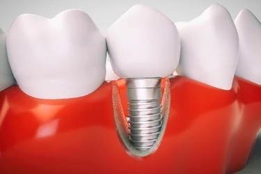 Special discount on dental implants