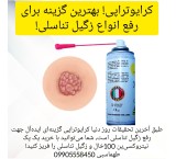 Sale of cryo spray for genital wart treatment