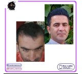 Natural hair transplant in one session