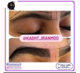 Natural eyebrow implantation in one session