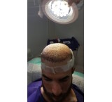 Hair transplant in Shiraz with special discount