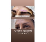 Super specialized eyebrow transplant in Shiraz with warranty
