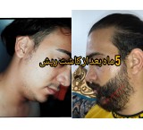 Shiraz hair transplant