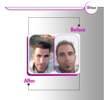 Natural hair transplant