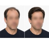 پروتز موی طبیعی و تعویض چسب پروتز