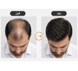 پروتز موی طبیعی و تعویض چسب پروتز