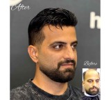 پروتز موی طبیعی و تعویض چسب پروتز