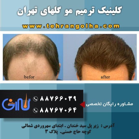 ترمیم مو گلهای تهران نماینده رسمی های فیکس آلمان