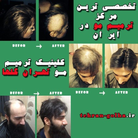 ترمیم مو گلهای تهران نماینده رسمی های فیکس آلمان