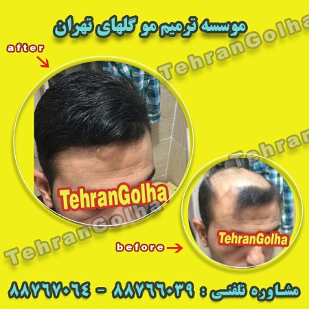 ترمیم مو گلهای تهران نماینده رسمی های فیکس آلمان