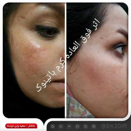 کرم زعفران درمان جای جوش و چین و چروک