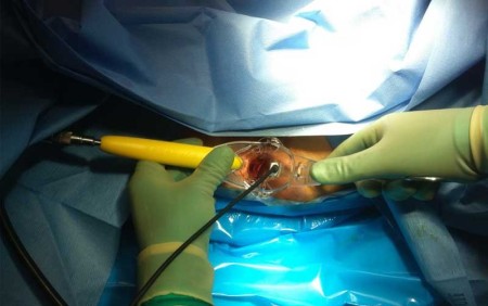 لیزر بواسیر یا هموروئید در کلینیک پایتخت