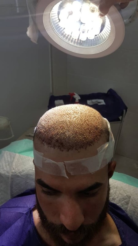 کاشت مو در شیراز با تخفیف ویژه