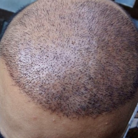 Hair transplant