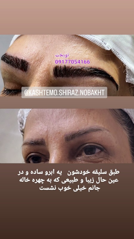Super specialized eyebrow transplant in Shiraz with warranty