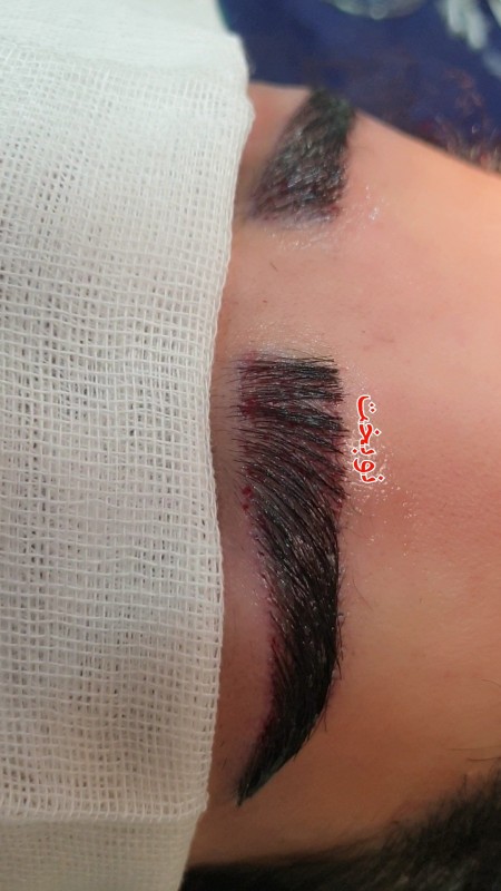 Super specialized eyebrow transplant in Shiraz with warranty