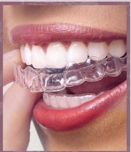 تخفیف -بلیچینگ