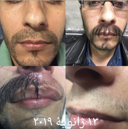 کاشت موی طبیعی Fit Fut ترکیبی DHI