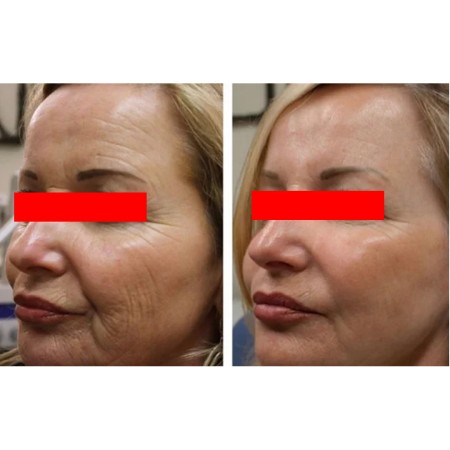 Model for HIFU facial beautification of Kivan Teb