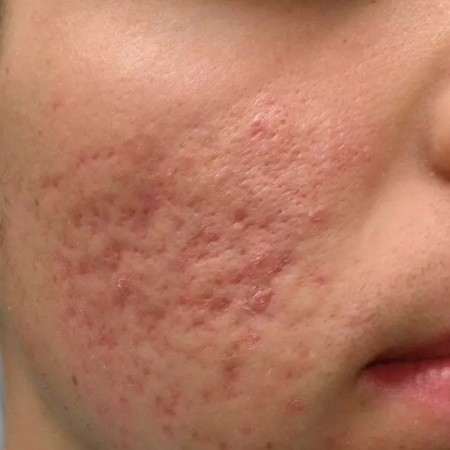 Treatment of pimples and acne scars by the beautifiers of Keyvan Teb