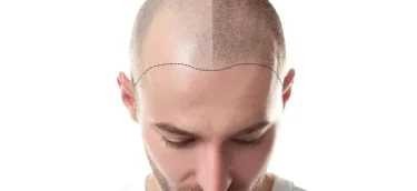 Hair transplant, eyebrow transplant, all beauty services