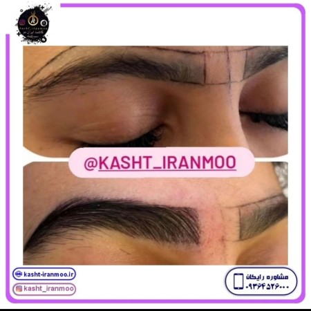 Natural eyebrow implantation in one session