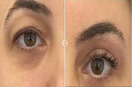 Blepharoplasty (correcting sagging eyelids)