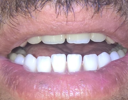 دندانسازی محلاتی اصفهان09162894028