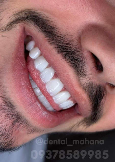 Composite Laminate Root Canal Treatment in Karaj at Mahana Dentistry