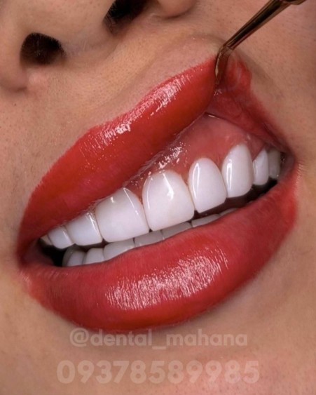 Composite Laminate Root Canal Treatment in Karaj at Mahana Dentistry