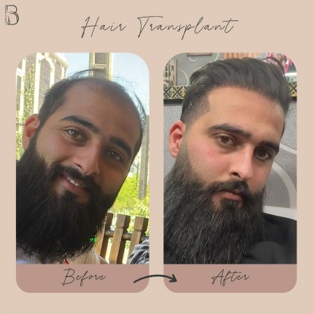 کاشت مو و ابرو با پرداخت 8 تومن و قسطی