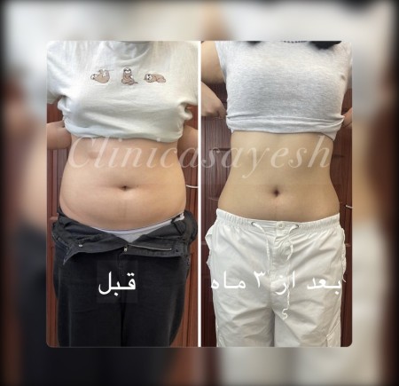 لاغری بدون جراحی با کرایولیپولیز