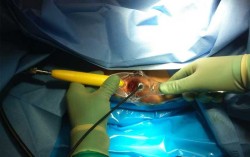 Hemorrhoid laser in the capital clinic