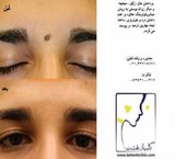 خال برداری