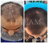 العلاج مضمونة لمنع تساقط الشعر وإعادة نمو الشعر