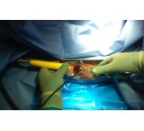 Hemorrhoid laser in the capital clinic